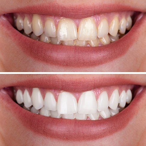 Side-by-side image of stained and whiter teeth