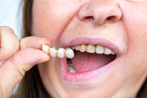 Dental Bridge Failure: What It Is And How To Avoid It